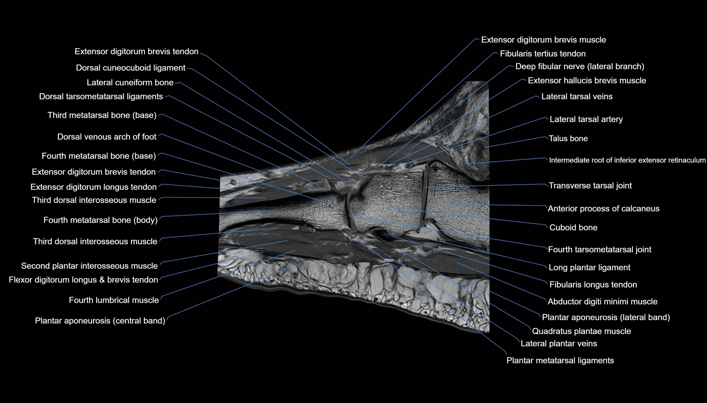 MRI mid foot sagittal cross sectional anatomy 3T  radiology  image-img-00001-00014.webp